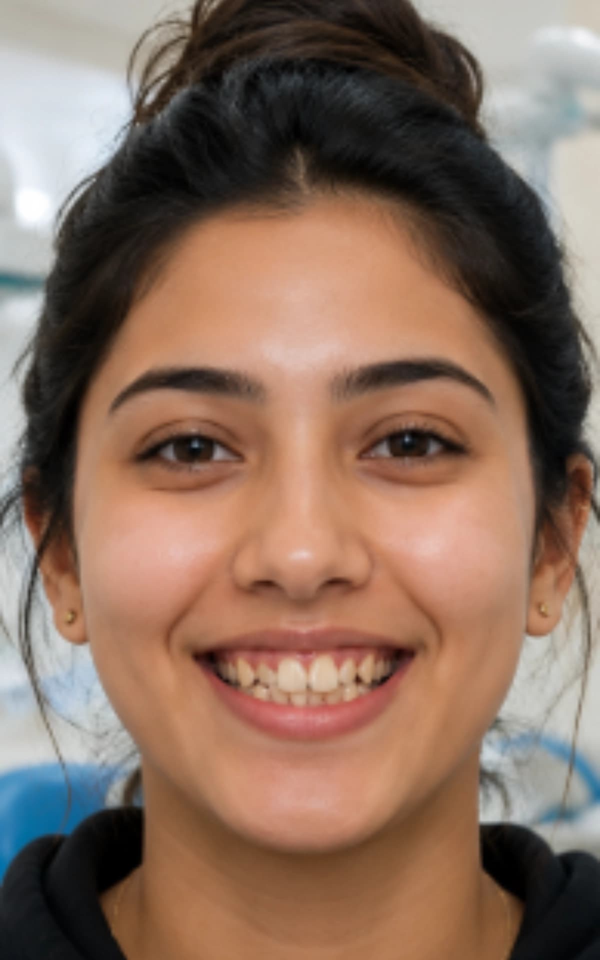 Before clear aligners treatment